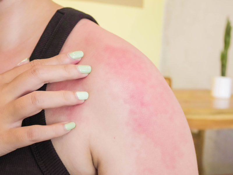 Do You Know Why Redheads Sunburn So Easily? 