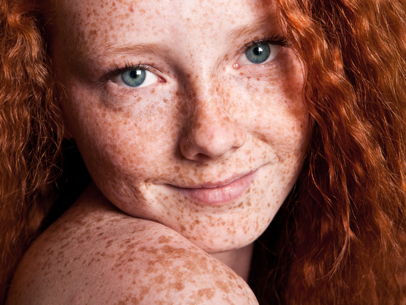 4 Best Hydrocortisone Cream Options for Redheads